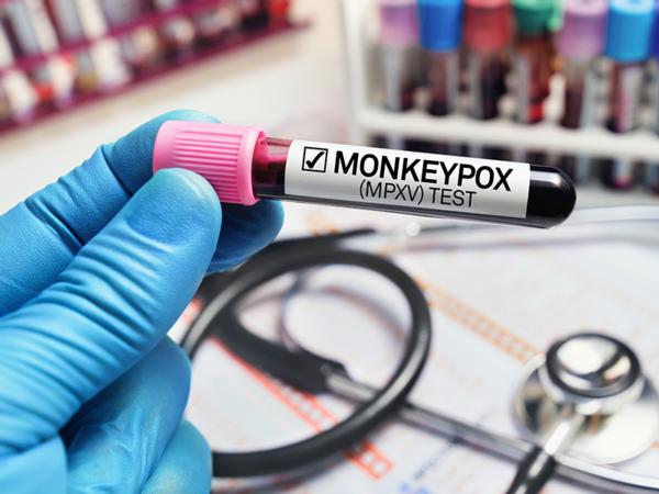 Monkeypox: What Is It and Should I Be Concerned?